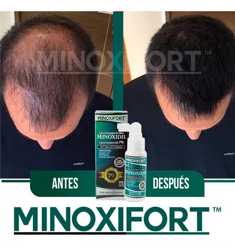 RevitaScalp Pro GRATIS Minoxifort